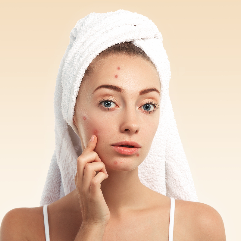 NuLaser: conheça o tratamento para acne (Foto:Free Pik/imagem meramente ilustrativa)